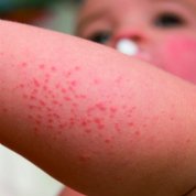 Risposte di psoriasi del mare Rosso
