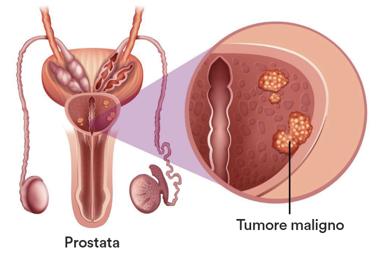 biopsia alla prostata fino a che eta la biopsia alla prostata fino a che eta la